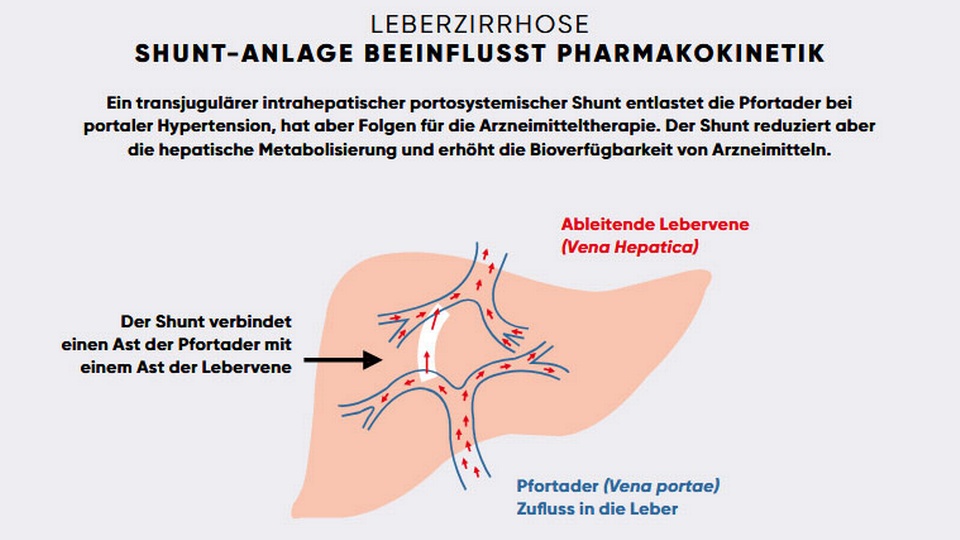 Leberzirrhose © APOVERLAG