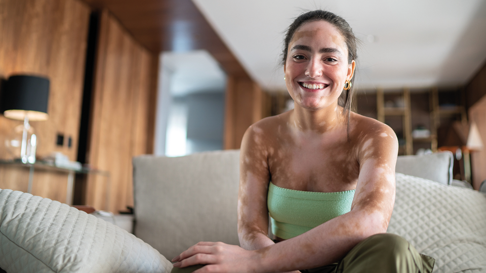 Vitiligo betrifft weltweit sch&auml;tzungsweise 0,5 bis 2 Prozent der Bev&ouml;lkerung und beginnt meist bereits im jungen Alter, h&auml;ufig zwischen dem 10. und 30. Lebensjahr. &copy; iStockphoto