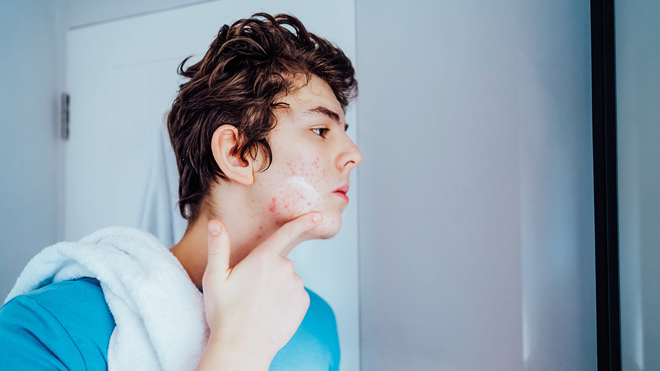 © iStock Akne bei Jugendlichem © iStock
