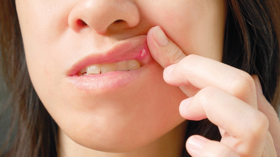 Aphthen und aphthoide Läsionen. © iStock