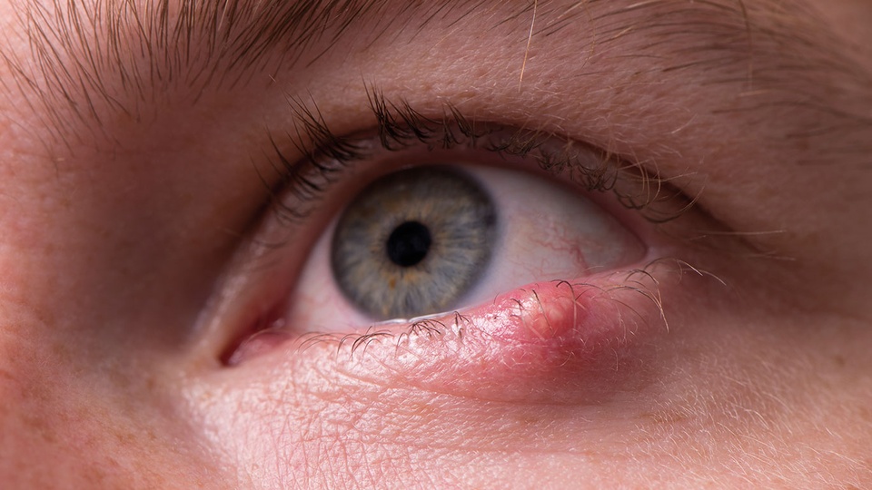© iStock Ein Gerstenkorn entsteht durch eine meist harmlose Infektion mit Staphylokokken. Aufgrund der bakteriellen Beteiligung können desinfizierende bzw. antibakterielle Augensalben und -tropfen den Heilungsprozess unterstützen. © iStock