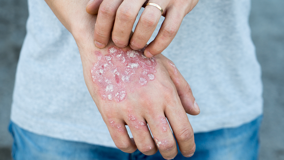 © Shutterstock Plaque-Psoriasis © Shutterstock