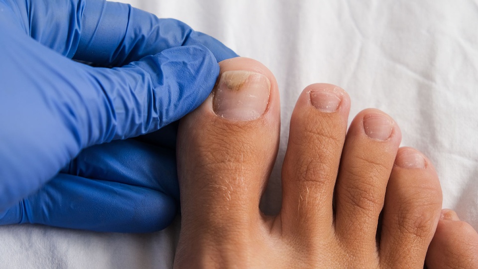 © shutterstock Nagelpilz © shutterstock