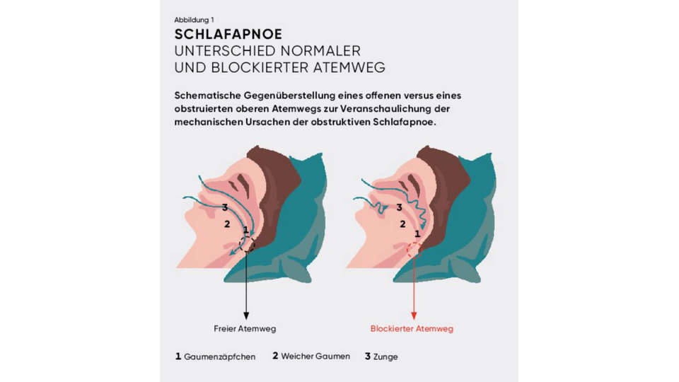 Schlafpnoe &copy; APOVERLAG